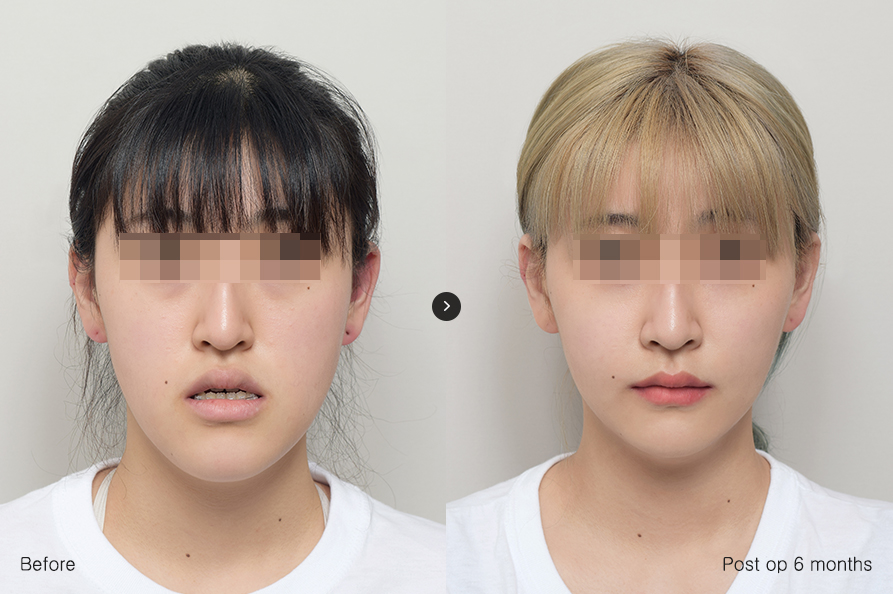 전후사진