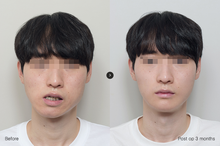 전후사진