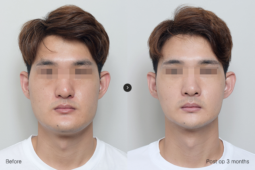 전후사진