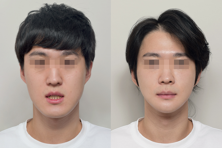 전후사진