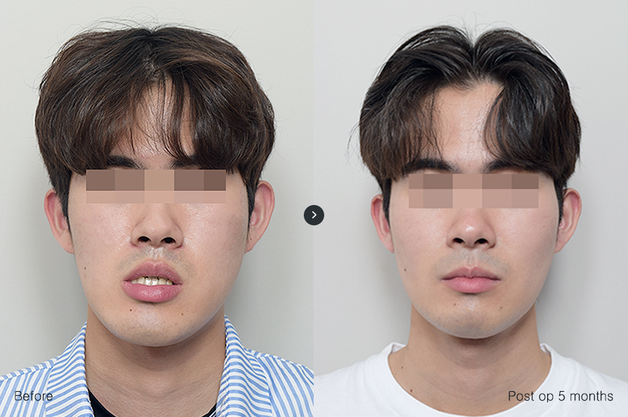 전후사진