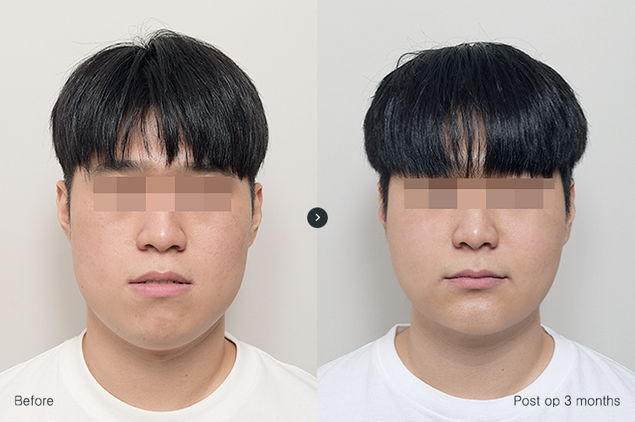 전후사진