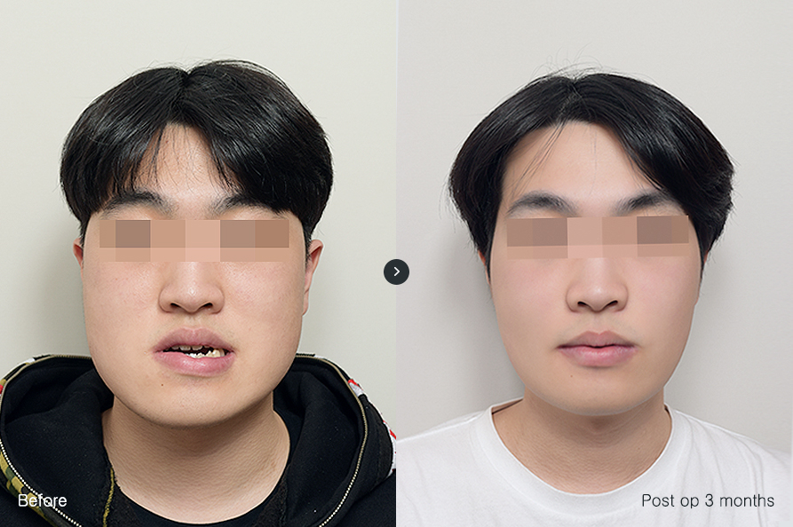 전후사진