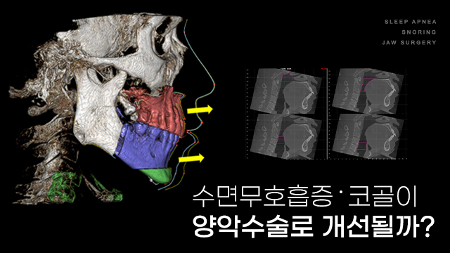 수면무호흡증·코골이, 양악수술과 턱끝수술로 개선될 수 있을까요?