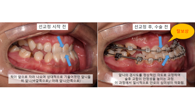 양악수술, 교정보다 수술을 먼저 받아도 될까요? 선수술이 가능한 기준